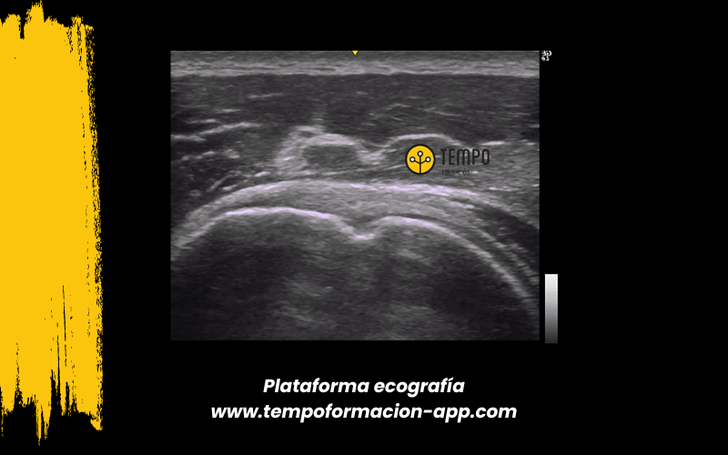 9. Ecografia tempo formacion manguito rotador tendon supraespinoso infraespinoso redondo menor subescapular.png